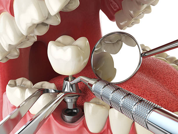 Best Emergency Wisdom Tooth Extraction in Ballard, UT